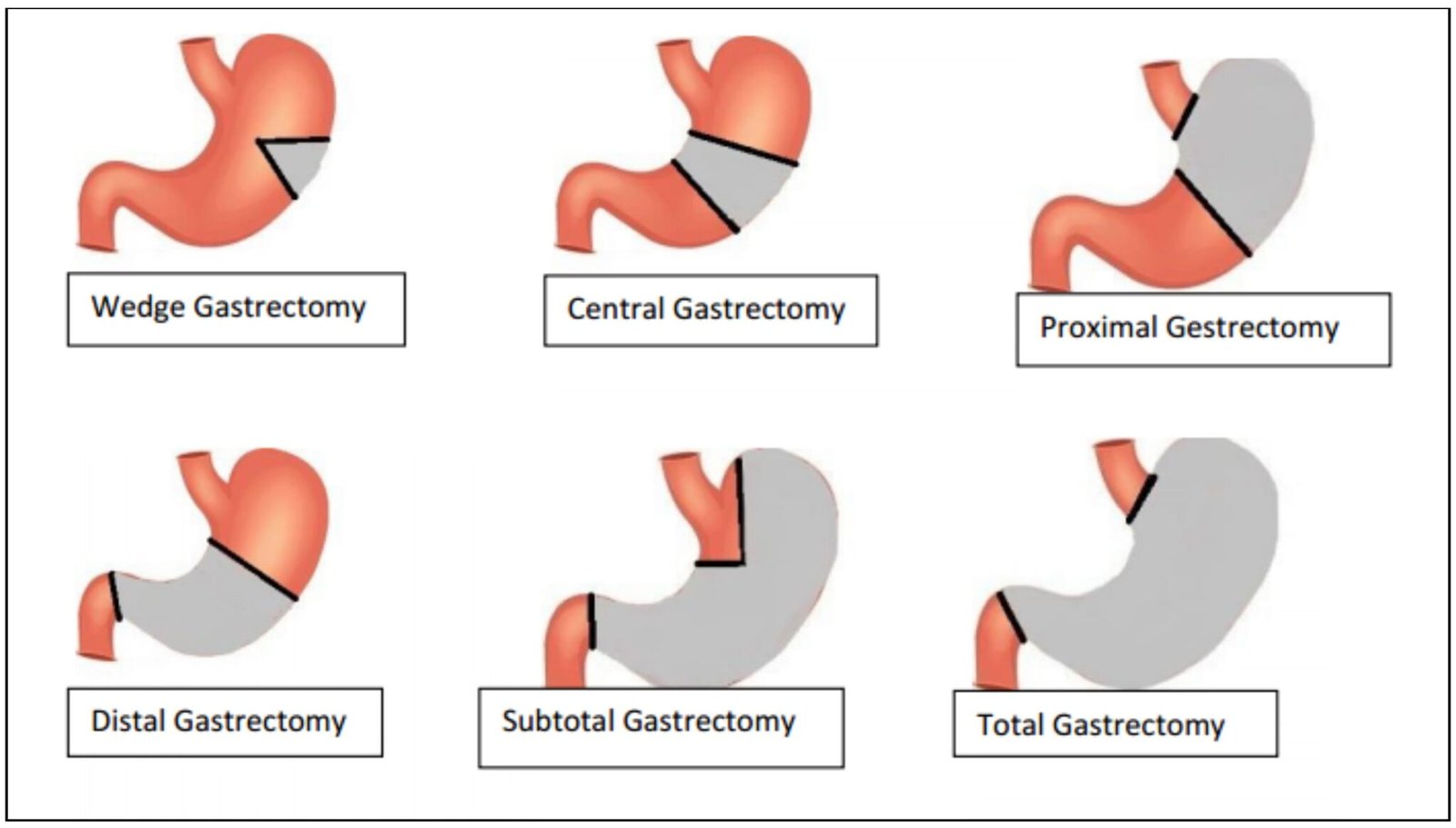 Gastric Cancer Surgery Best Stomach Cancer Doctor In Chennai