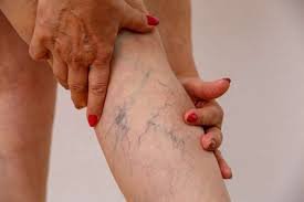 Varicose veins Itching