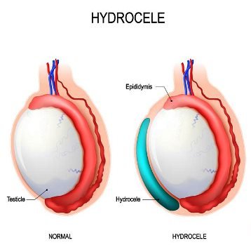 Signs and Symptoms for Hydrocele