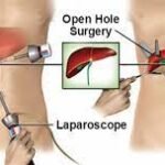 Laparoscopic Surgery for Hernia