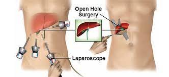 Laparoscopic Surgery for Hernia