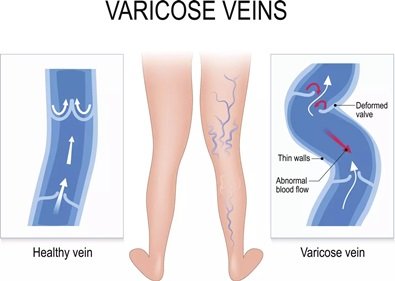 Dr. Durai Ravi Varicose Veins Surgeon