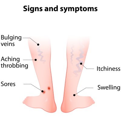 Signs and symptoms of Varicose Veins