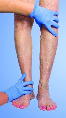 Treatment for Varicose Veins