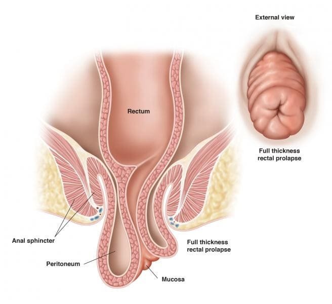 Dr Durai Ravi Surgeon for Rectal prolapse