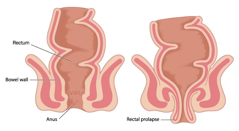 Causes for Rectal Prolapse