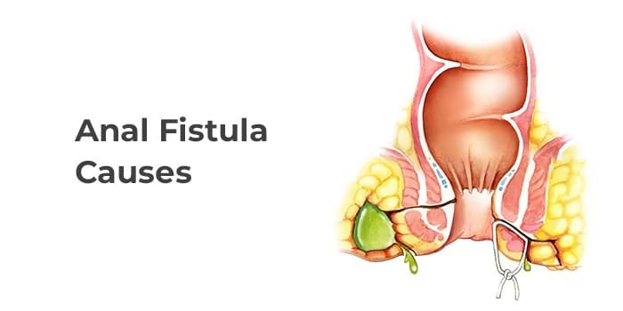 Causes for Anal Fistula