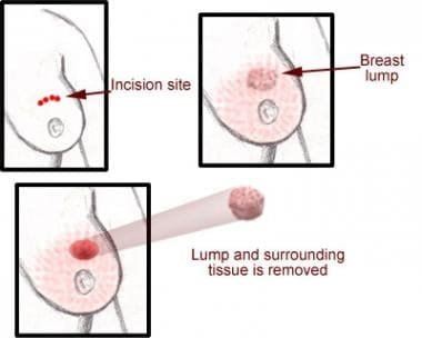 Breast lump treatment