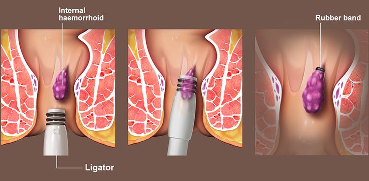 Painless Treatment for Hemorrhoids