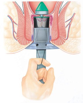 Treatment for Hemorrhoids at home