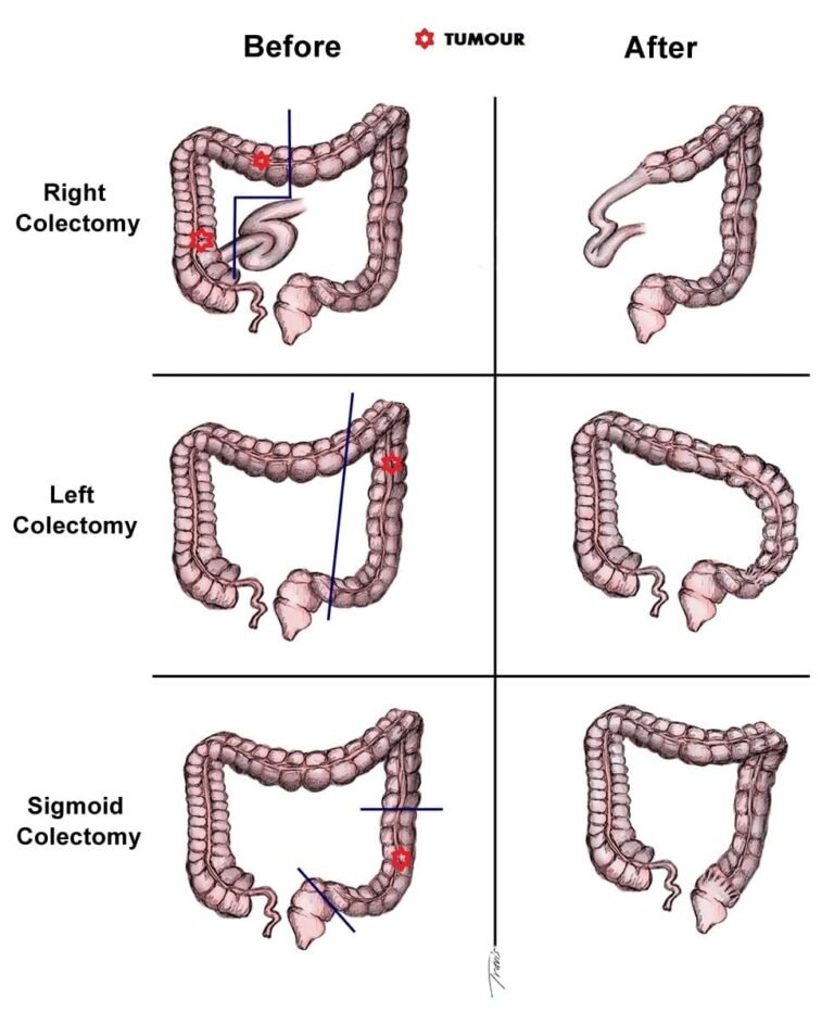 Right,Left and Sigmoid colectomy