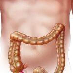 Causes for Appendicitis