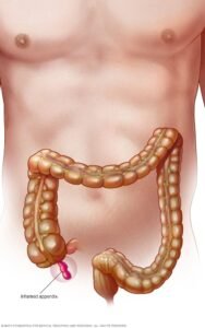 Causes for Appendicitis