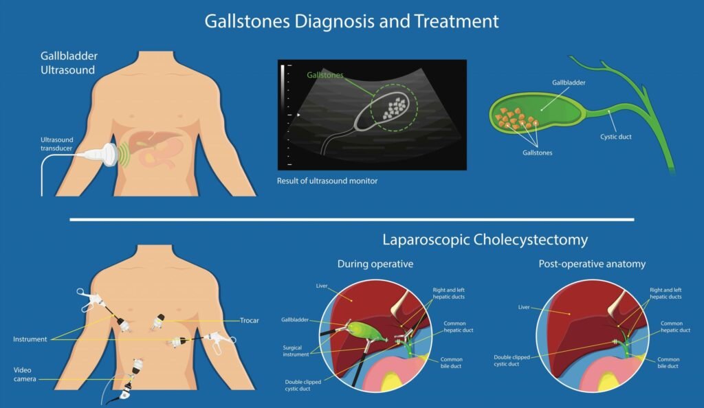 Cholelithiasis Treatment in Chennai