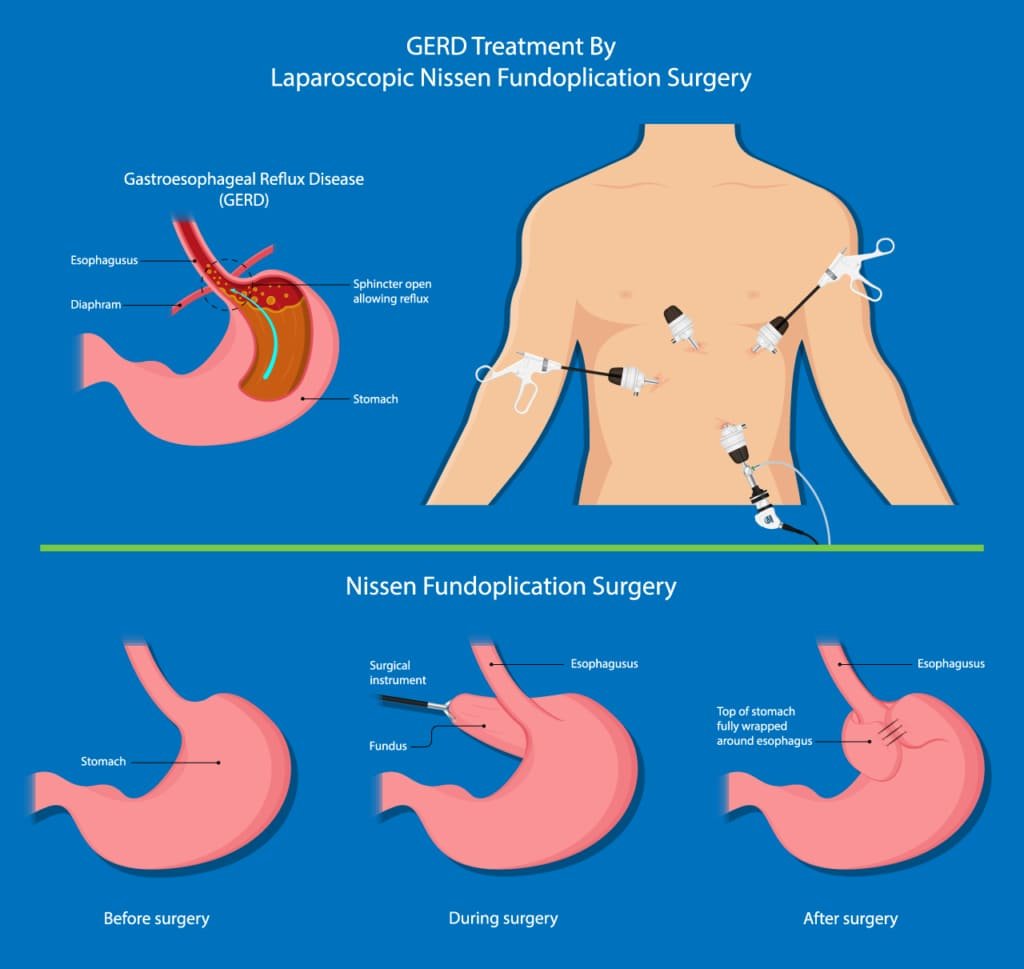 Gastroesophageal Reflux Disease (GERD): Understanding the Causes, Symptoms, and Treatment
