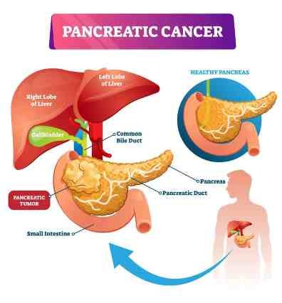 Dr. Durai Ravi surgeon for Pancreatic Cancer