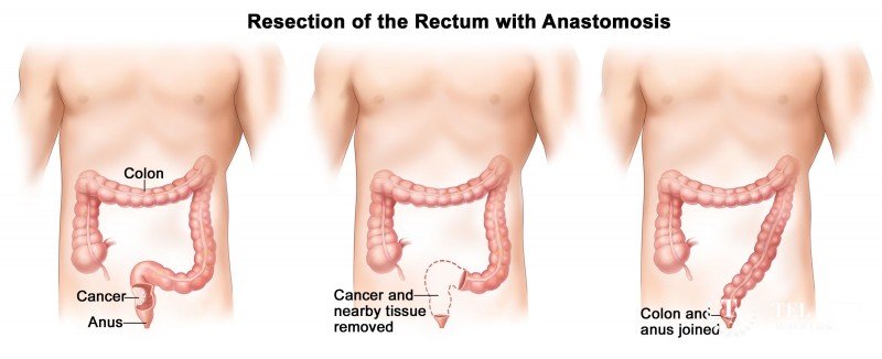 Resection of the Rectum with Anastomosis