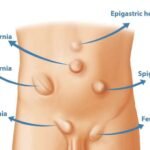 Hernia Surgeon Dr. Durai Ravi