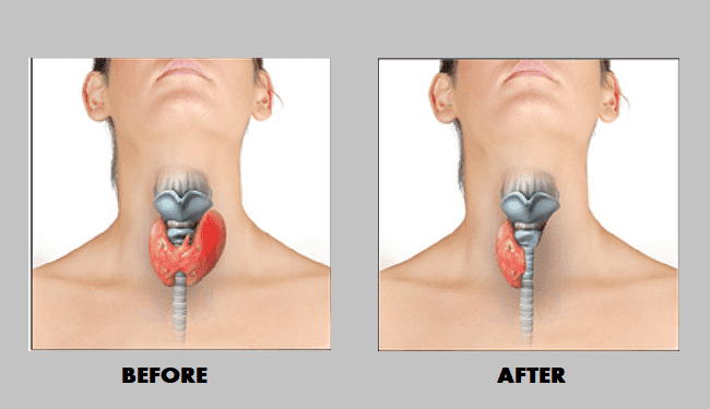Thyroid Surgery Durai the Surgeon
