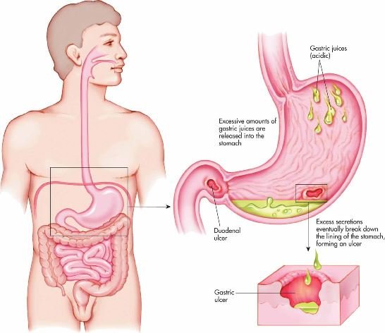 Complication for Stomach Ulcer
