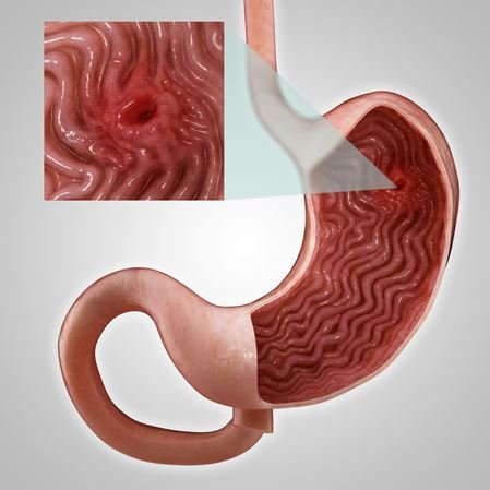 Diagnosis for Stomach Ulcer