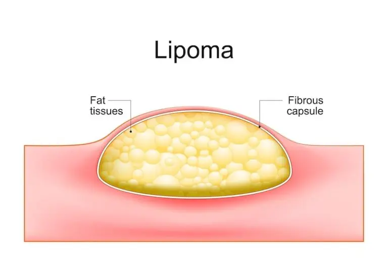 lipoma Dr Durai Ravi Surgeon