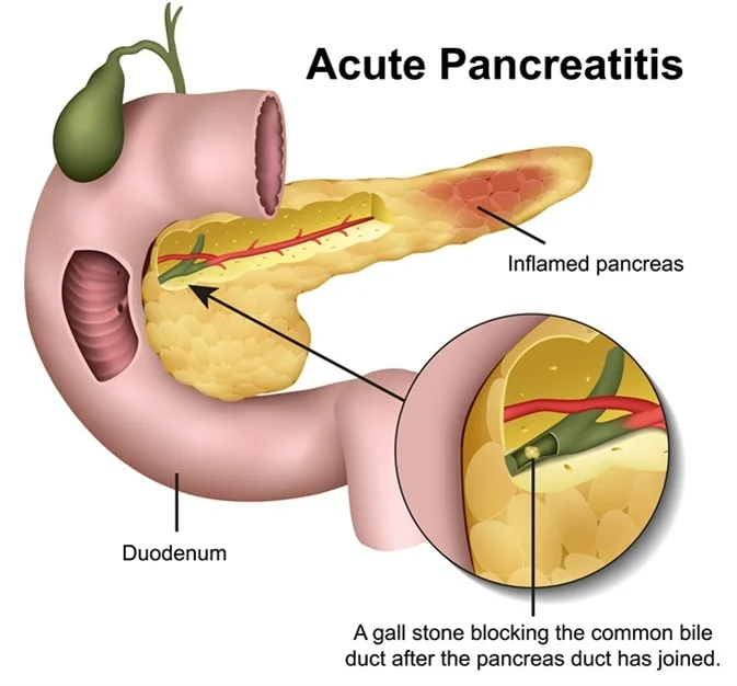 Causes for Pancreatitis