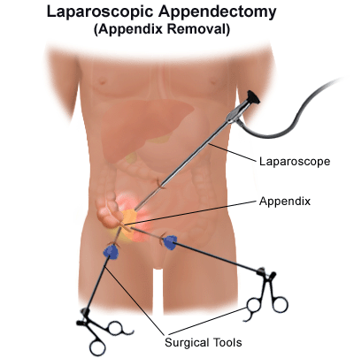 Appendicitis treatment in Chennai