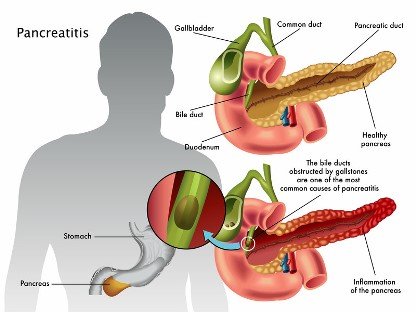 Affected by Pancreatitis￼