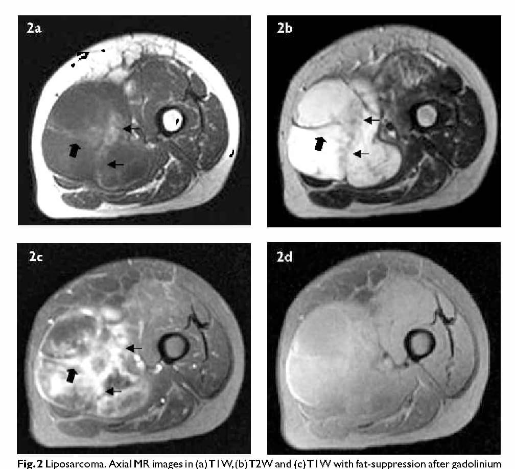 Diagnosis and Test for Lipoma