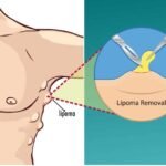 lipoma treatment in Chennai