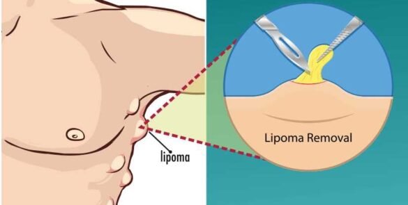 Lipoma Vs Cancer Lump Signs And Symptoms