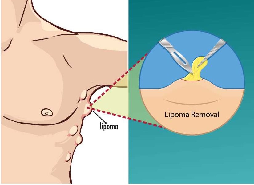 lipoma treatment in Chennai
