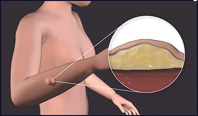 Lipoma- symptom - Dr Durai Ravi
