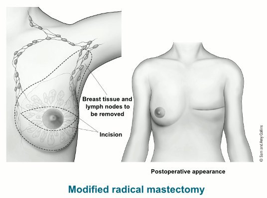 Mastectomy Breast Surgery in Chennai