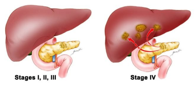 Stages for Pancreatic Cancer