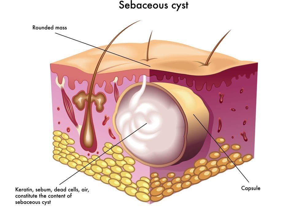 sebaceous-gland-cyst-under-skin