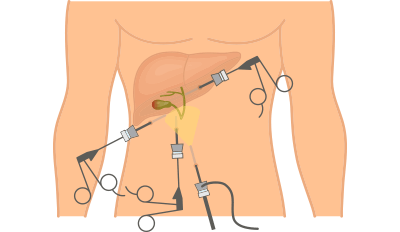 surgical-treatment-of-gallbladder