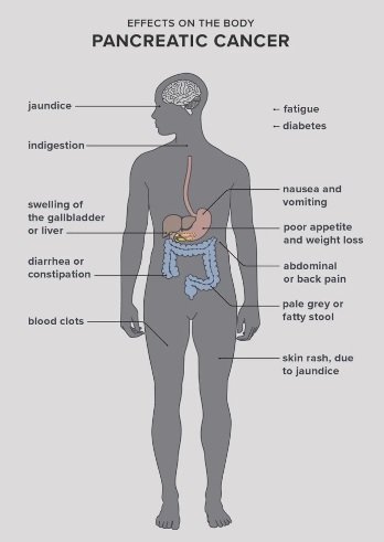 Symptoms for Pancreatic Cancer