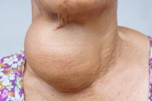 Signs and Symptoms for Thyroid