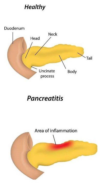 Treatment for pancreatitis