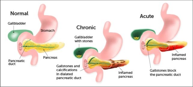 Types of Pancreatitis