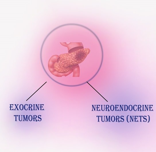 Types of Pancreatic Cancer