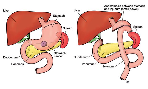 Stomach Cancer Durai The Surgeon