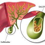 Gallstone Stones by Dr Durai Ravi