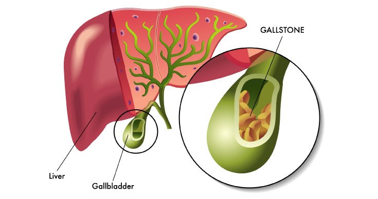 How to prevent Gallbladder Stones – Dr Durai Ravi