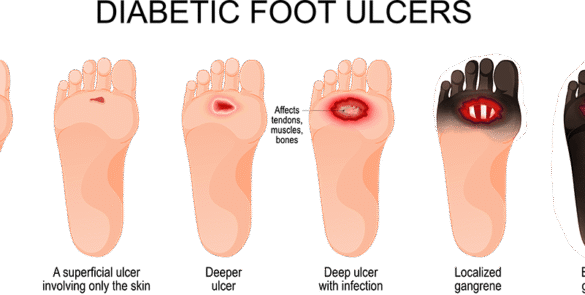Diabetic Foot Ulcers Causes Treatment OMR Chennai
