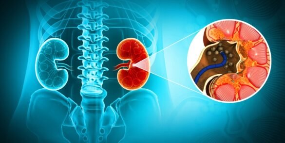 Gallstones vs Kidney Stones: When to See a Surgeon?